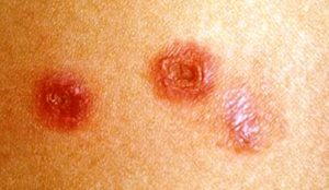 impetigine