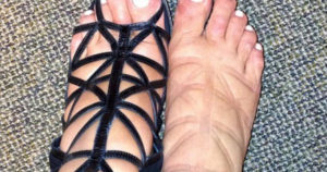 piedi-gonfi