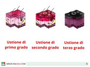 trattamento-ustioni