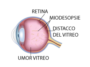 distacco-del-vitreo