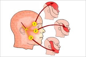 trigemino