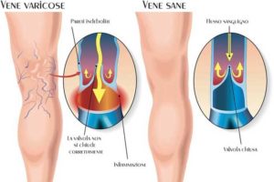 insufficienza-venosa-cronica