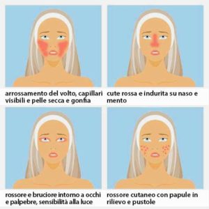 TIPI-DI-ROSACEA